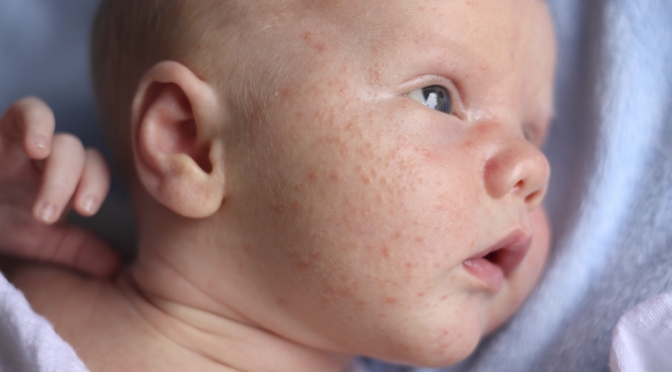 Kleine Pickel Rote Haut Wenn Das Baby Hautausschlag Hat Mibaby Magazin Ratgeber Testberichte Fur Eltern