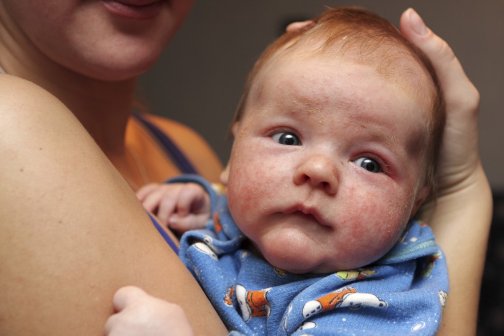 Kleine Pickel Rote Haut Wenn Das Baby Hautausschlag Hat Mibaby Magazin Ratgeber Testberichte Fur Eltern